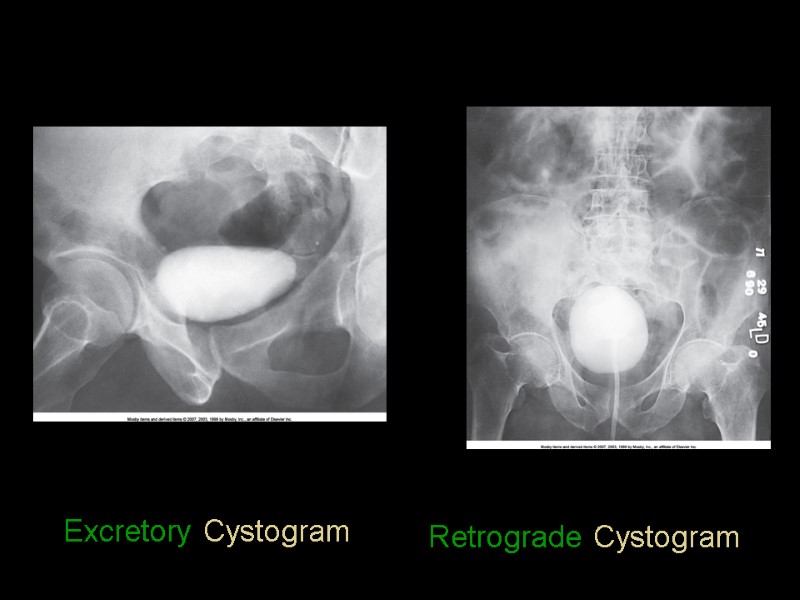 Excretory Cystogram Retrograde Cystogram